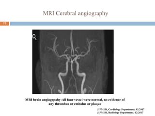 MRI Cerebral angiography
12
MRI brain angiogrpahy-All four vessel were normal, no evidence of
any thrombus or embolus or plaque
JIPMER, Cardiology Department, 02/2017
JIPMER, Radiology Department, 02/2017
 
