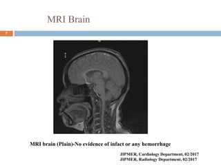 MRI Brain
7
JIPMER, Cardiology Department, 02/2017
JIPMER, Radiology Department, 02/2017
MRI brain (Plain)-No evidence of infact or any hemorrhage
 