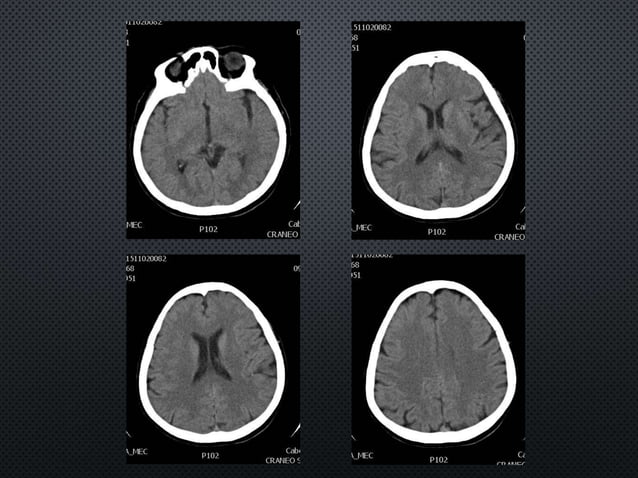 Infarto Cerebral Agudo PPT
