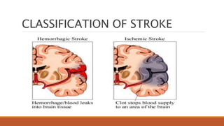 CLASSIFICATION OF STROKE
 