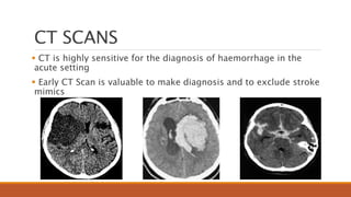 CT SCANS
 CT is highly sensitive for the diagnosis of haemorrhage in the
acute setting
 Early CT Scan is valuable to make diagnosis and to exclude stroke
mimics
 