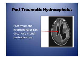 Stroke Care of Patient With Post Decompressive Craniectomy | PDF