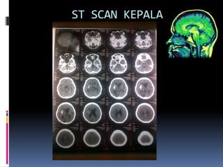 ST SCAN KEPALA
 