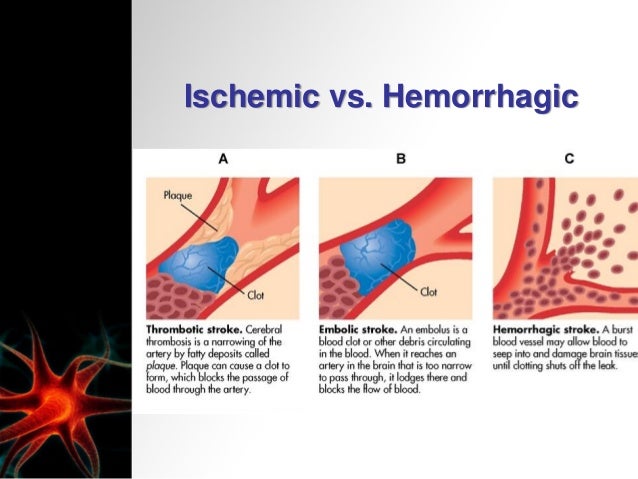 stroke-cerebrovascular-accident-16-638.jpg