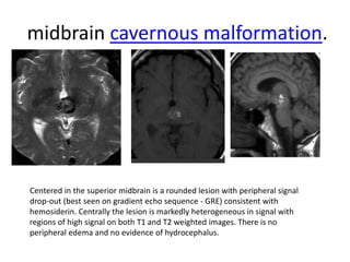 Midbrain Defect cerebral vascular malformation | PPTX