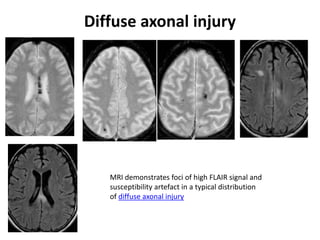 cerebral vascular malformation | PPTX