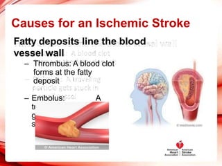 Causes for an Ischemic Stroke
Fatty deposits line the blood
vessel wall
– Thrombus: A blood clot
forms at the fatty
deposit
– Embolus: A
traveling particle
gets stuck in a
small vessel
 