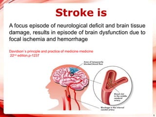 5
Stroke is
A focus episode of neurological deficit and brain tissue
damage, results in episode of brain dysfunction due to
focal ischemia and hemorrhage
Davidson`s principle and practice of medicine medicine
22nd edition,p-1237
 