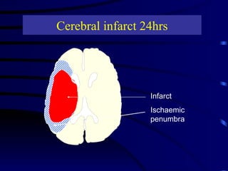 Cerebral infarct 24hrs Infarct Ischaemic penumbra 