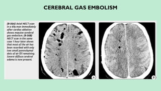 CEREBRAL GAS EMBOLISM
 