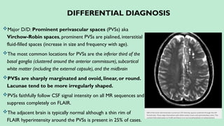 DIFFERENTIAL DIAGNOSIS
Major D/D: Prominent perivascular spaces (PVSs) aka
Virchow-Robin spaces, prominent PVSs are pialined, interstitial
fluid-filled spaces (increase in size and frequency with age).
The most common locations for PVSs are the inferior third of the
basal ganglia (clustered around the anterior commissure), subcortical
white matter (including the external capsule), and the midbrain
PVSs are sharply marginated and ovoid, linear, or round.
Lacunae tend to be more irregularly shaped.
PVSs faithfully follow CSF signal intensity on all MR sequences and
suppress completely on FLAIR.
The adjacent brain is typically normal although a thin rim of
FLAIR hyperintensity around the PVSs is present in 25% of cases.
 