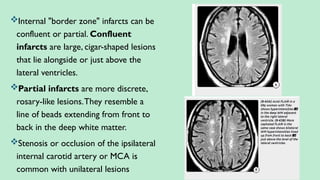 Internal "border zone" infarcts can be
confluent or partial. Confluent
infarcts are large, cigar-shaped lesions
that lie alongside or just above the
lateral ventricles.
Partial infarcts are more discrete,
rosary-like lesions.They resemble a
line of beads extending from front to
back in the deep white matter.
Stenosis or occlusion of the ipsilateral
internal carotid artery or MCA is
common with unilateral lesions
 