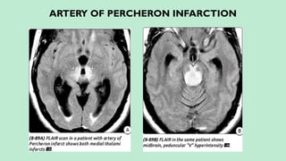ARTERY OF PERCHERON INFARCTION
 