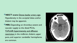 NECT scans: Dense basilar artery sign.
Hypodensity in the occipital lobes and/or
thalami may be apparent.
MRI: Depending on thrombus extent and
vascular supply to the distal PCAs.
T2/FLAIR hyperintensity and diffusion
restriction in the midbrain, thalami, upper
pons, and superior cerebellar hemispheres
are common.
 