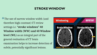 STROKEWINDOW
The use of narrow window width (and
therefore high-contrast) CT review
settings i.e. “stroke windows” 40
Window width (WW) and 40 Window
level (WL) as an integral part of the
general evaluation of CT brain
examination helps to increase detection of
subtle, potentially significant lesions.
 