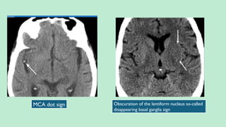 Obscuration of the lentiform nucleus so-called
disappearing basal ganglia sign
MCA dot sign
 