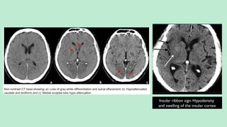 Insular ribbon sign: Hypodensity
and swelling of the insular cortex
 
