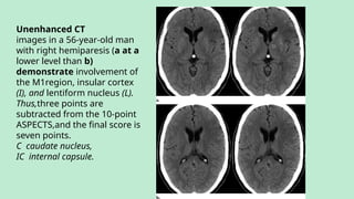 Unenhanced CT
images in a 56-year-old man
with right hemiparesis (a at a
lower level than b)
demonstrate involvement of
the M1region, insular cortex
(I), and lentiform nucleus (L).
Thus,three points are
subtracted from the 10-point
ASPECTS,and the final score is
seven points.
C caudate nucleus,
IC internal capsule.
 
