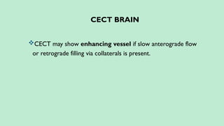 CECT BRAIN
CECT may show enhancing vessel if slow anterograde flow
or retrograde filling via collaterals is present.
 