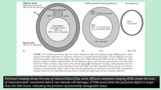 Perfusion imaging shows the area of reduced blood flow, while diffusion-weighted imaging (DWI) shows the area
of restricted water movement (which can indicate cell damage). A PDM exists when the perfusion deficit is larger
than the DWI lesion, indicating the presence of potentially salvageable tissue.
 