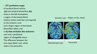  CT perfusion maps
of cerebral blood volume
(a) and cerebral blood flow (b)
show, in the left hemisphere,
a region of decreased blood
volume (white oval) that corresponds
to the ischemic core
and a larger region of decreased
blood flow (black oval
in b) that includes the ischemic
core and a peripheral
region of salvageable tissue.
The difference between the
two maps (black oval white
oval) is the penumbra.
Ischemic core Region of dec. blood
Penumbra
Well perfused area
 