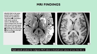 MRI FINDINGS
Highly specific predictor for malignant MCA infarct is threshold core volume of more then 82 cc.
 