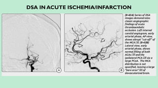 DSA IN ACUTE ISCHEMIA/INFARCTION
 