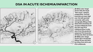 DSA IN ACUTE ISCHEMIA/INFARCTION
 