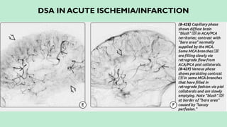 DSA IN ACUTE ISCHEMIA/INFARCTION
 