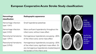 European Cooperative Acute Stroke Study classification:
 
