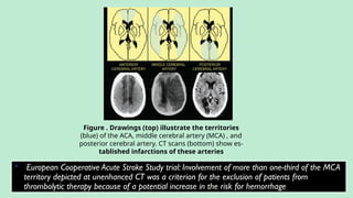 Figure . Drawings (top) illustrate the territories
(blue) of the ACA, middle cerebral artery (MCA) , and
posterior cerebral artery. CT scans (bottom) show es-
tablished infarctions of these arteries
 European Cooperative Acute Stroke Study trial: Involvement of more than one-third of the MCA
territory depicted at unenhanced CT was a criterion for the exclusion of patients from
thrombolytic therapy because of a potential increase in the risk for hemorrhage
 