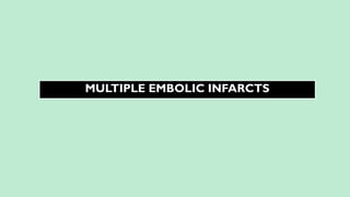 MULTIPLE EMBOLIC INFARCTS
 