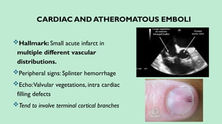 CARDIAC AND ATHEROMATOUS EMBOLI
Hallmark: Small acute infarct in
multiple different vascular
distributions.
Peripheral signs: Splinter hemorrhage
Echo:Valvular vegetations, intra cardiac
filling defects
Tend to involve terminal cortical branches
 