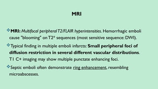 MRI
MRI: Multifocal peripheralT2/FLAIR hyperintensities. Hemorrhagic emboli
cause "blooming" onT2* sequences (most sensitive sequence: DWI).
Typical finding in multiple emboli infarcts: Small peripheral foci of
diffusion restriction in several different vascular distributions.
T1 C+ imaging may show multiple punctate enhancing foci.
Septic emboli often demonstrate ring enhancement, resembling
microabscesses.
 