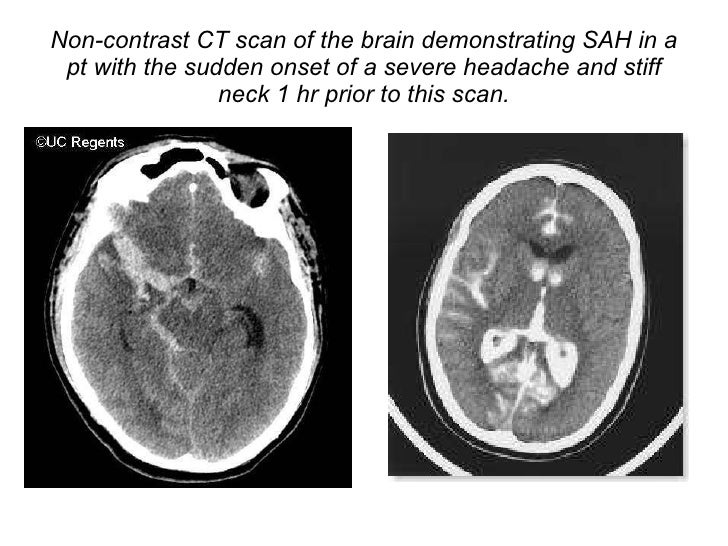 Non Contrast Ct For Sah : Subarachnoid Hemorrhage (SAH) – BZLU