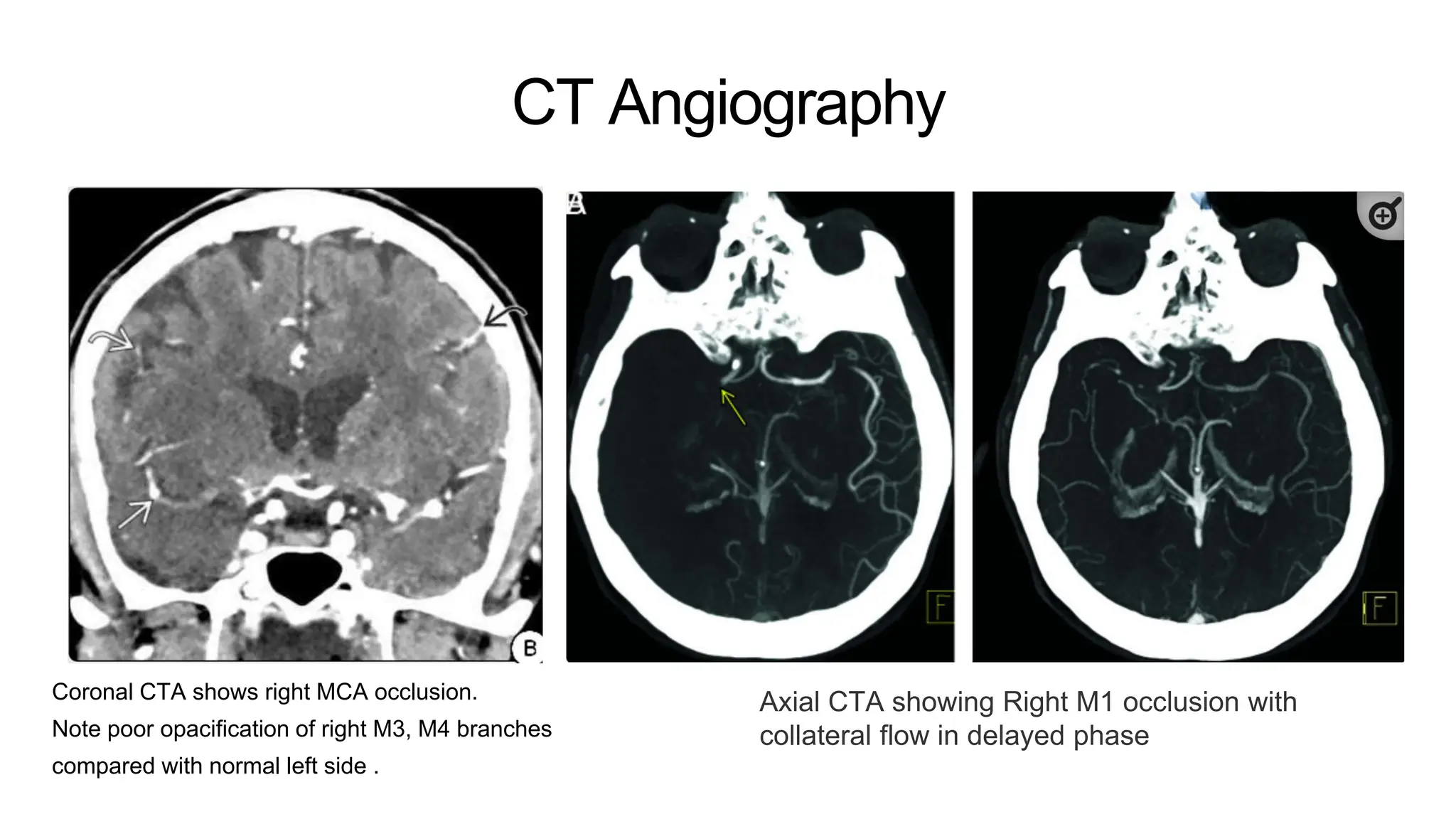 CT Angiography
Coronal CTA shows right MCA occlusion.
Note poor opacification of right M3, M4 branches
compared with normal left side .
Axial CTA showing Right M1 occlusion with
collateral flow in delayed phase
 