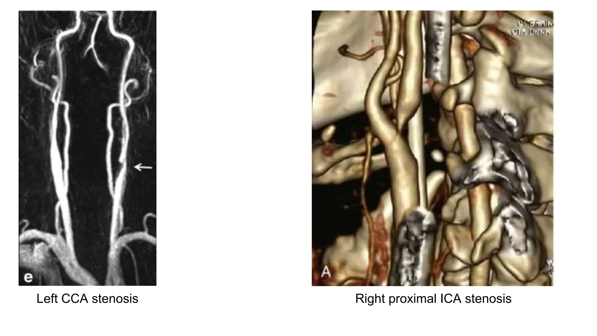 Left CCA stenosis Right proximal ICA stenosis
 