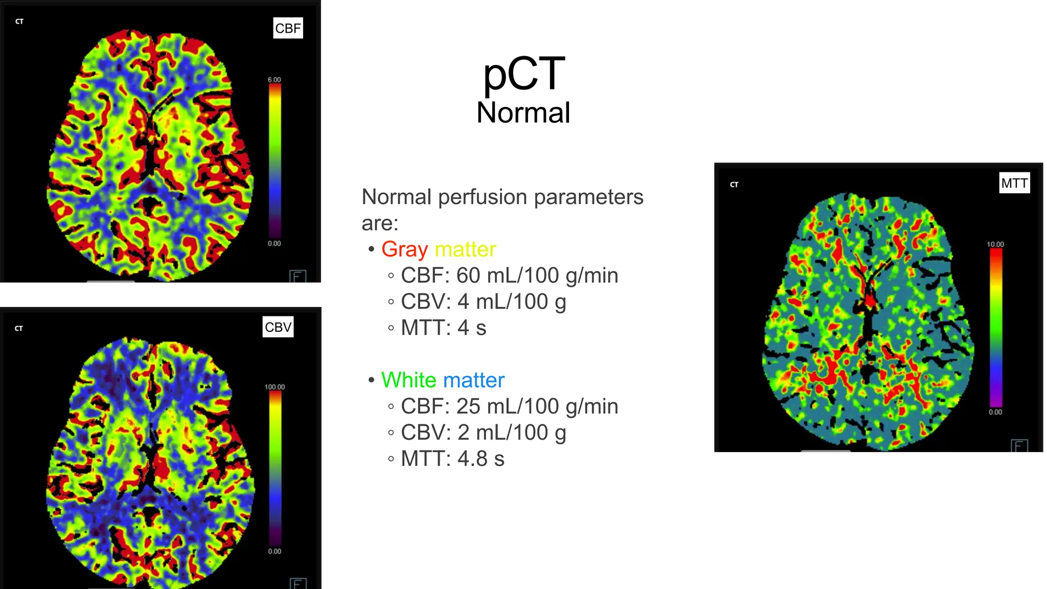 pCT
Normal
CBV
CBF
CBV
MTT
Normal perfusion parameters
are:
• Gray matter
◦ CBF: 60 mL/100 g/min
◦ CBV: 4 mL/100 g
◦ MTT: 4 s
• White matter
◦ CBF: 25 mL/100 g/min
◦ CBV: 2 mL/100 g
◦ MTT: 4.8 s
 