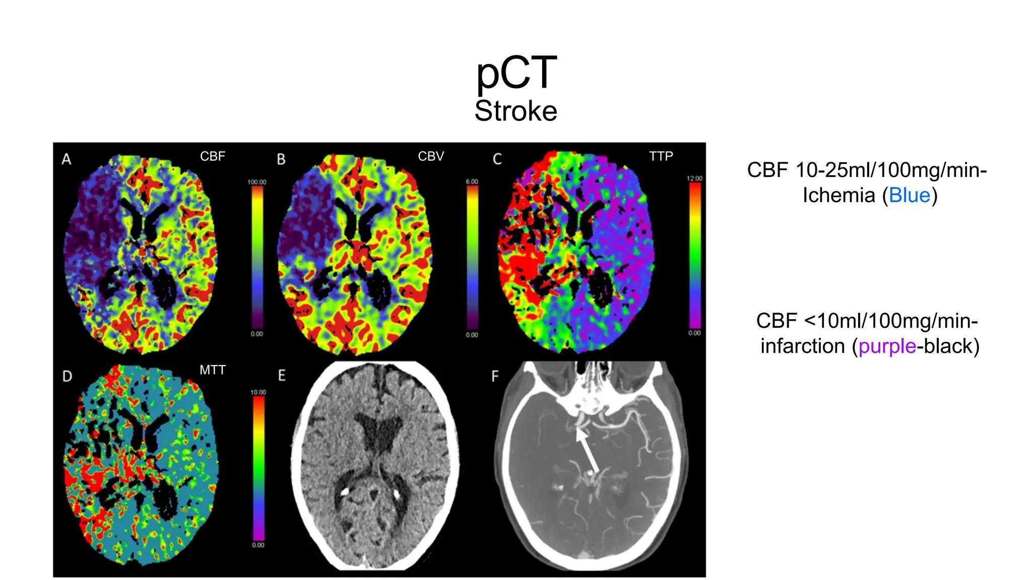 pCT
Stroke
CBF CBV TTP
MTT
CBF 10-25ml/100mg/min-
Ichemia (Blue)
CBF <10ml/100mg/min-
infarction (purple-black)
 
