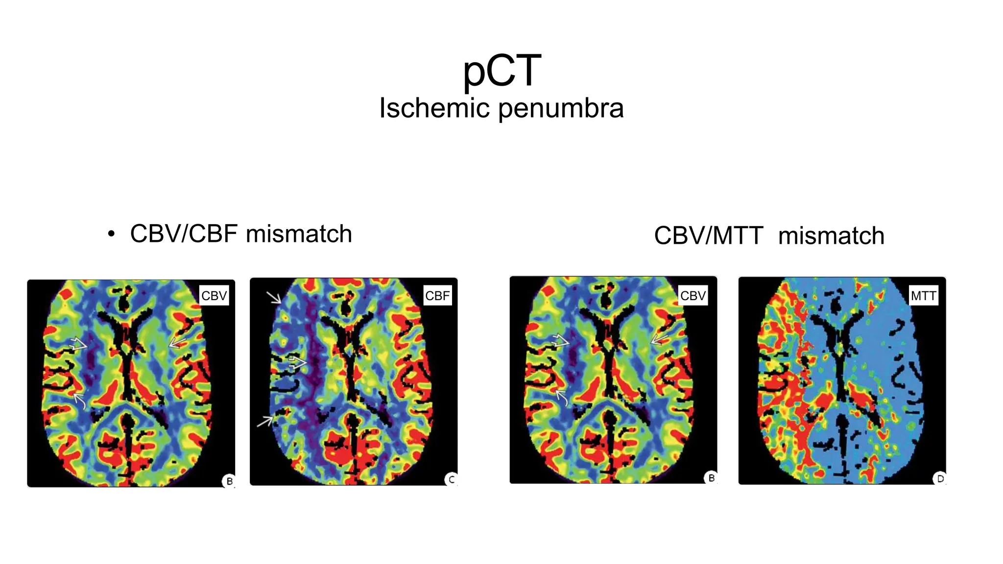 pCT
Ischemic penumbra
• CBV/CBF mismatch
CBV CBF
CBV/MTT mismatch
CBV MTT
 