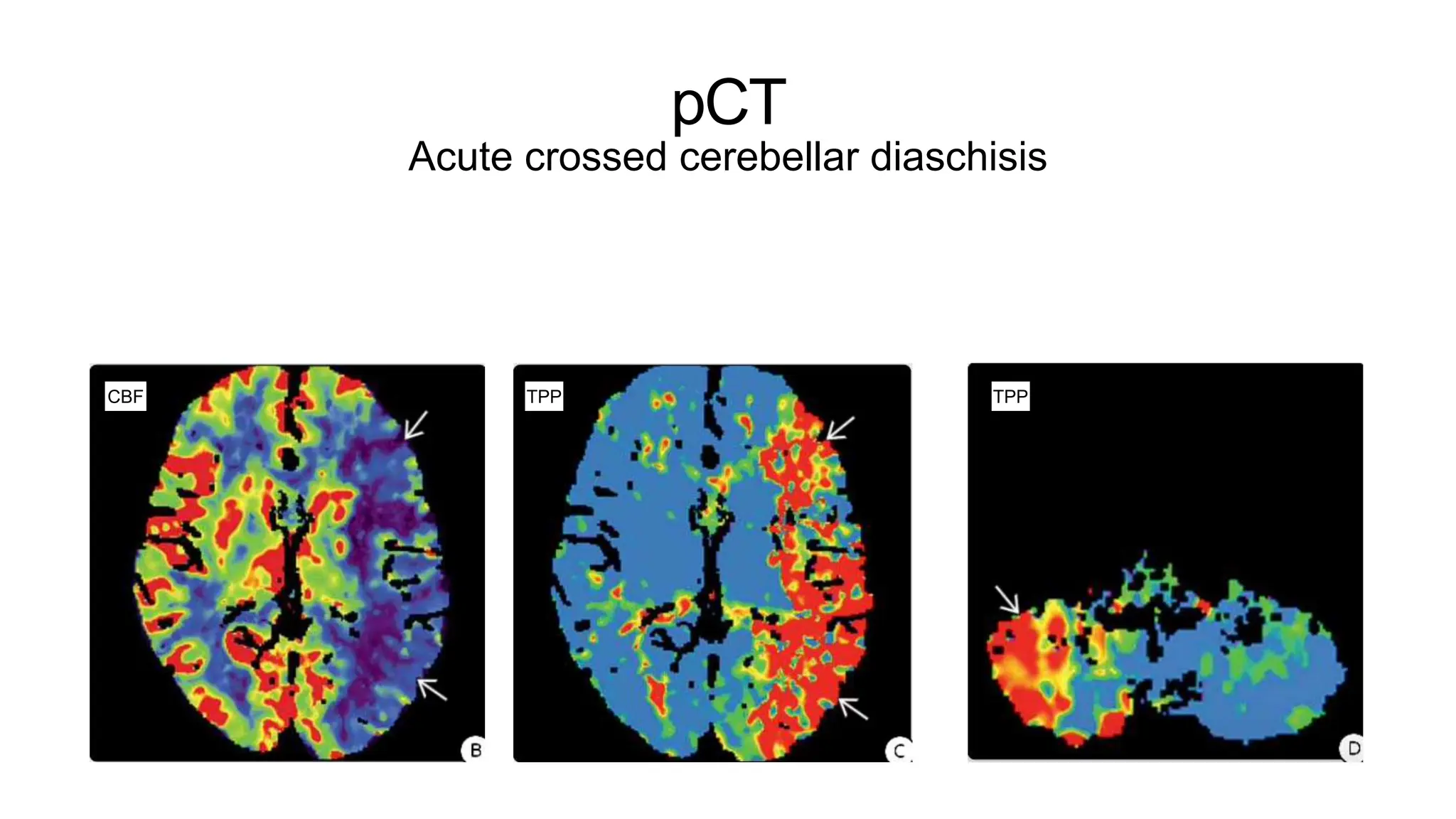 pCT
Acute crossed cerebellar diaschisis
CBF TPP
TPP
 