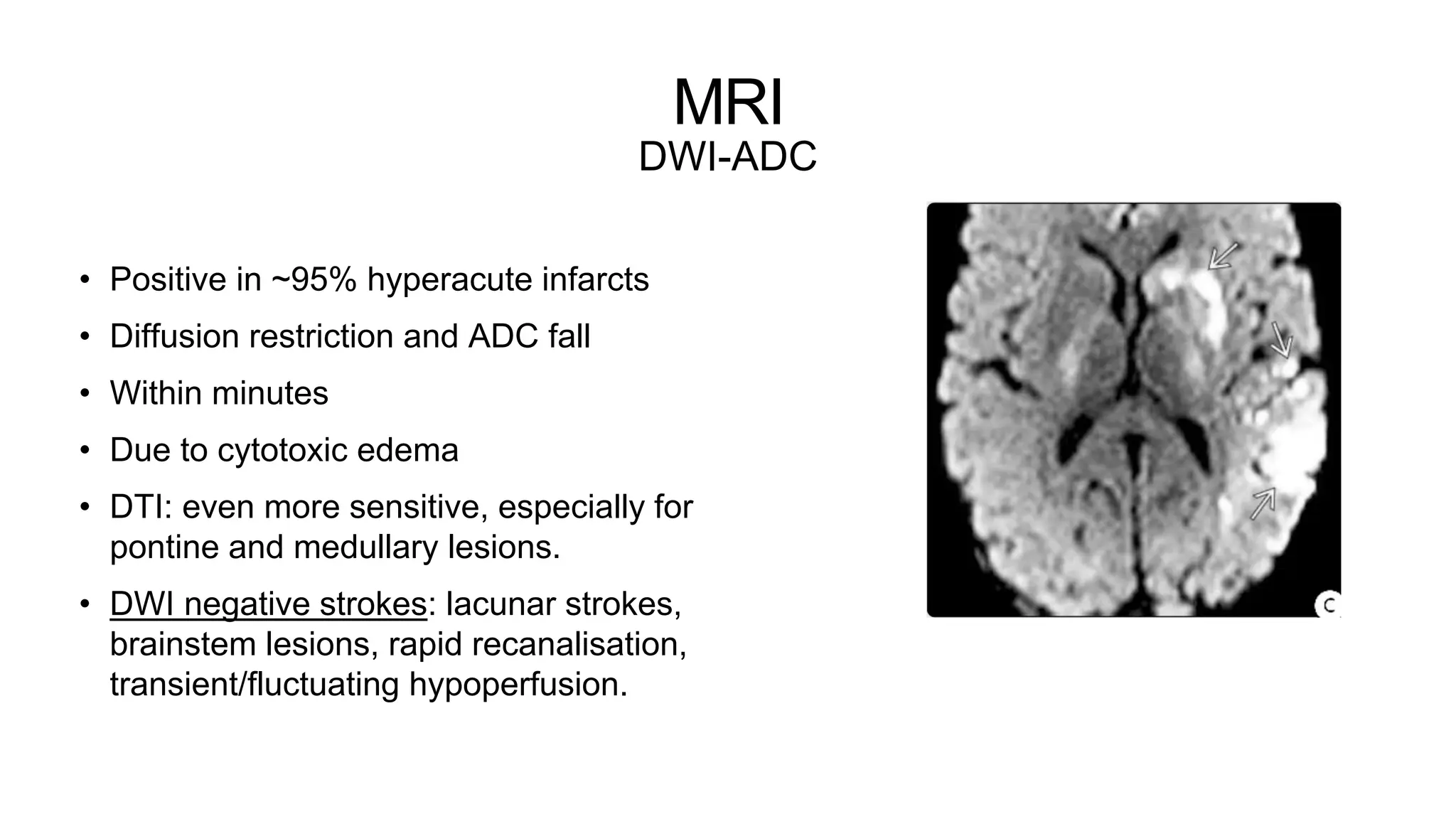 MRI
DWI-ADC
• Positive in ~95% hyperacute infarcts
• Diffusion restriction and ADC fall
• Within minutes
• Due to cytotoxic edema
• DTI: even more sensitive, especially for
pontine and medullary lesions.
• DWI negative strokes: lacunar strokes,
brainstem lesions, rapid recanalisation,
transient/fluctuating hypoperfusion.
 