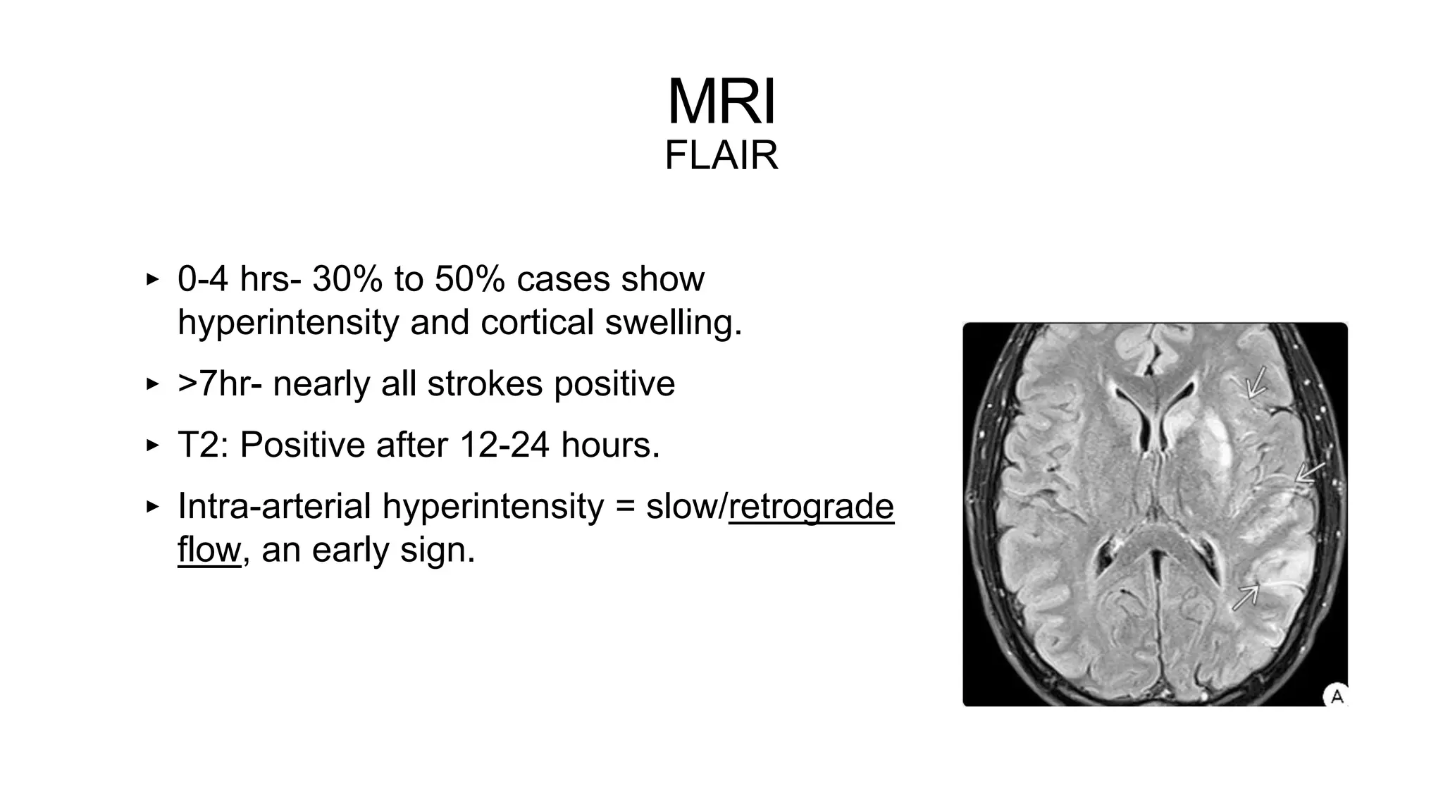 MRI
FLAIR
‣ 0-4 hrs- 30% to 50% cases show
hyperintensity and cortical swelling.
‣ >7hr- nearly all strokes positive
‣ T2: Positive after 12-24 hours.
‣ Intra-arterial hyperintensity = slow/retrograde
flow, an early sign.
 