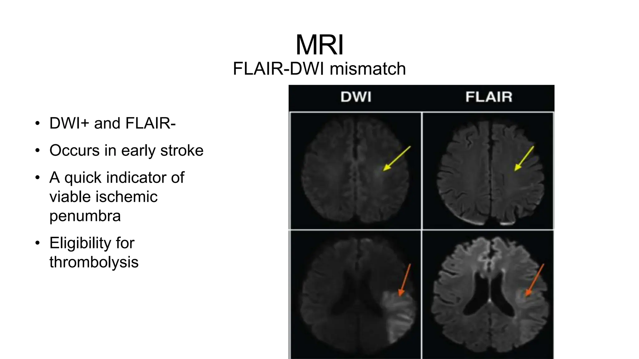 MRI
FLAIR-DWI mismatch
• DWI+ and FLAIR-
• Occurs in early stroke
• A quick indicator of
viable ischemic
penumbra
• Eligibility for
thrombolysis
 