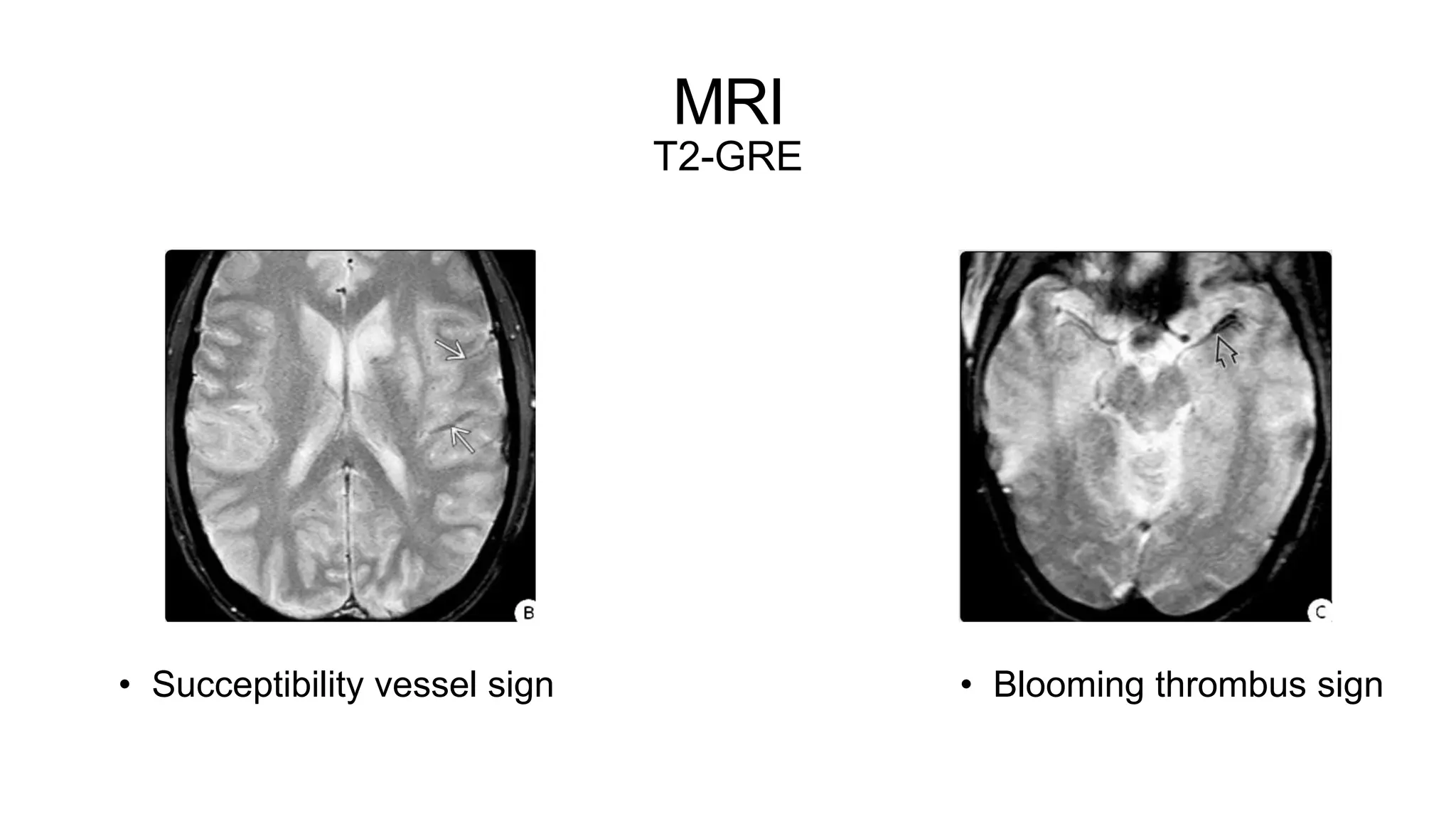 MRI
T2-GRE
• Blooming thrombus sign
• Succeptibility vessel sign
 