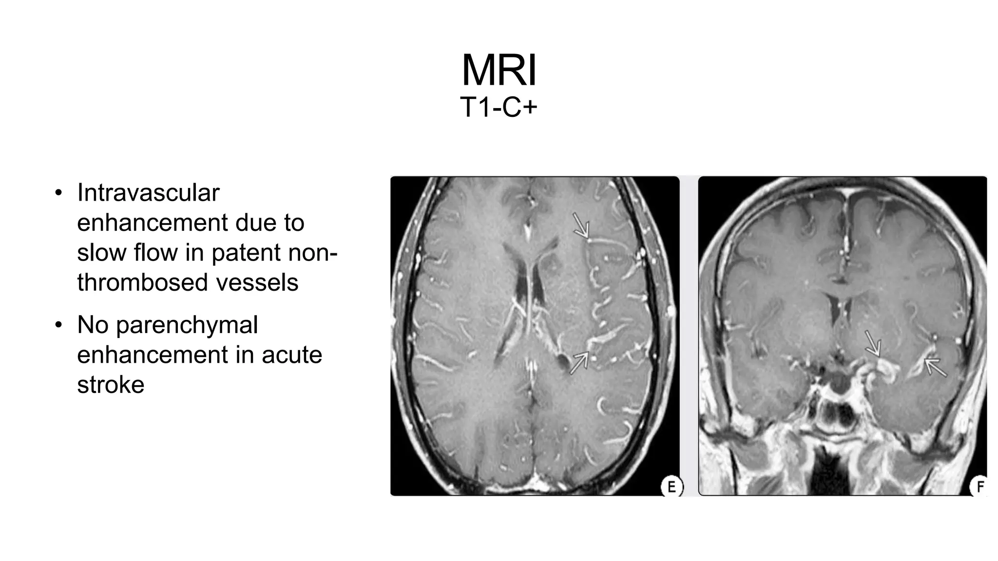MRI
T1-C+
• Intravascular
enhancement due to
slow flow in patent non-
thrombosed vessels
• No parenchymal
enhancement in acute
stroke
 