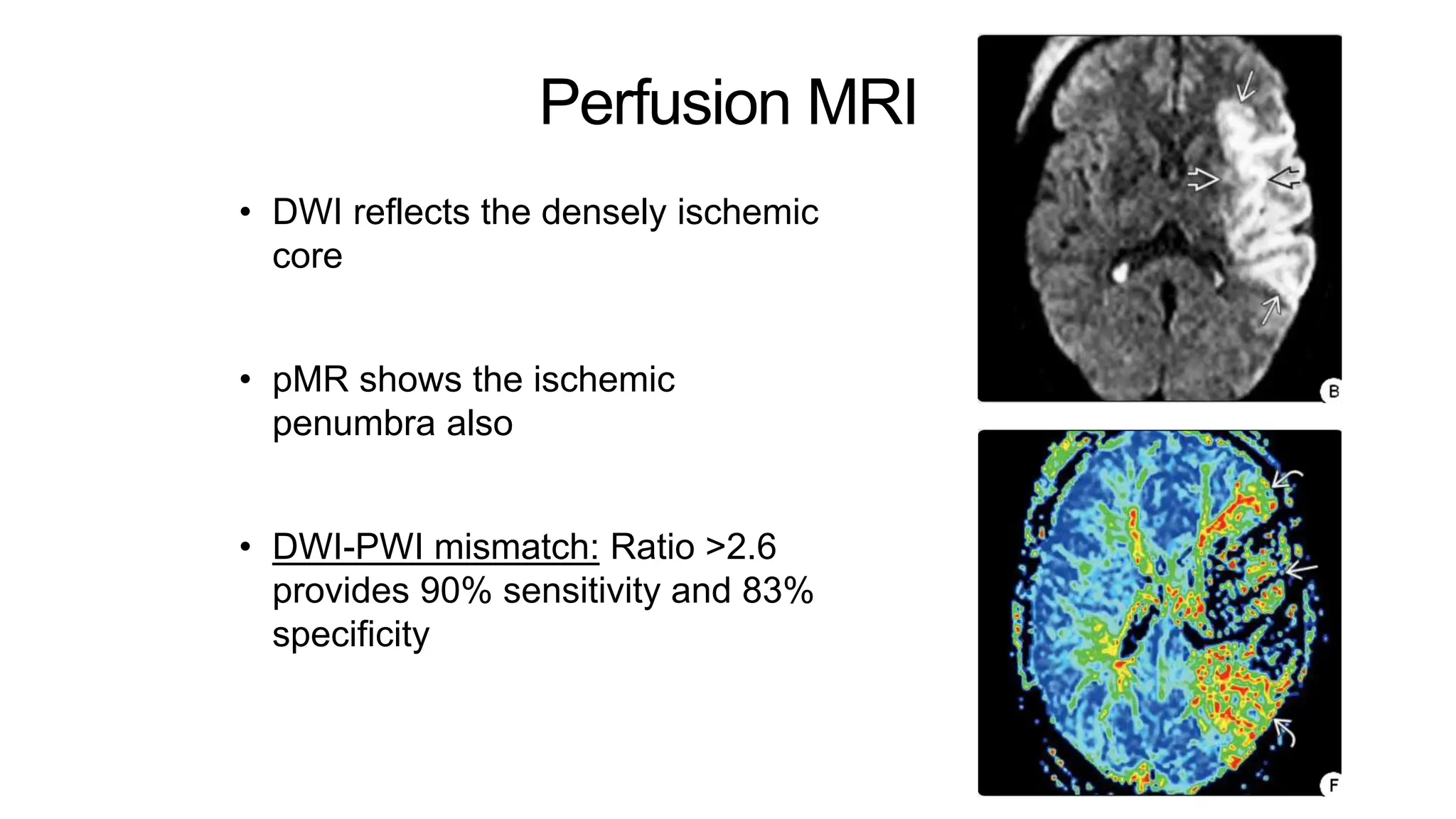 Perfusion MRI
• DWI reflects the densely ischemic
core
• pMR shows the ischemic
penumbra also
• DWI-PWI mismatch: Ratio >2.6
provides 90% sensitivity and 83%
specificity
 