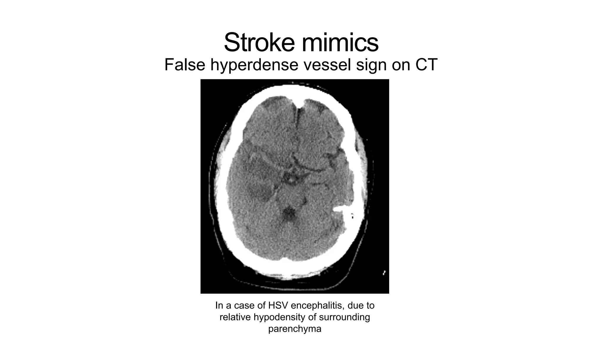 Stroke mimics
False hyperdense vessel sign on CT
In a case of HSV encephalitis, due to
relative hypodensity of surrounding
parenchyma
 