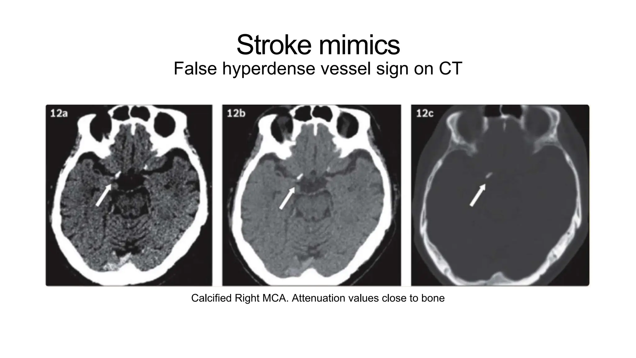 Stroke mimics
False hyperdense vessel sign on CT
Calcified Right MCA. Attenuation values close to bone
 