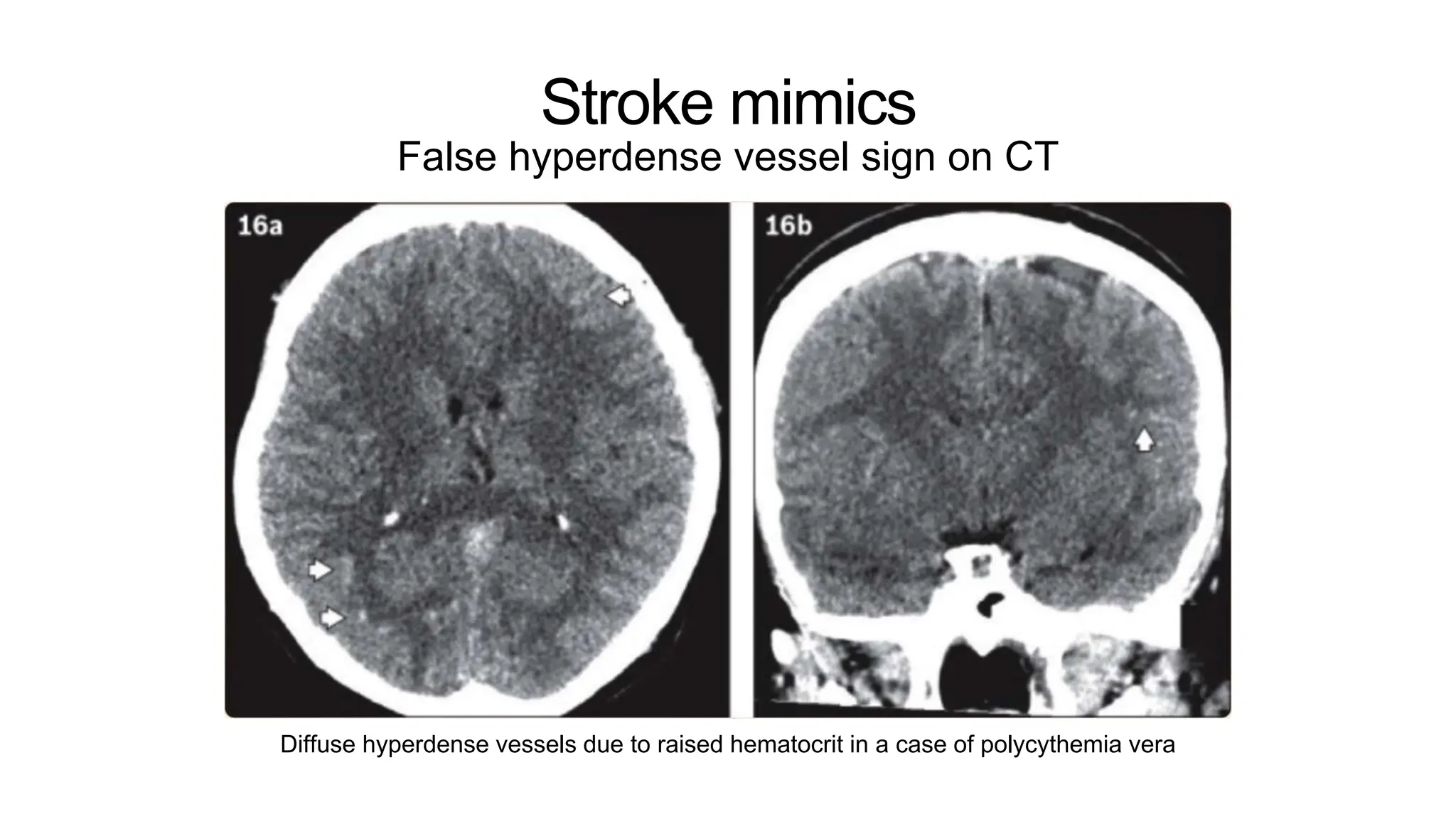 Stroke mimics
False hyperdense vessel sign on CT
Diffuse hyperdense vessels due to raised hematocrit in a case of polycythemia vera
 
